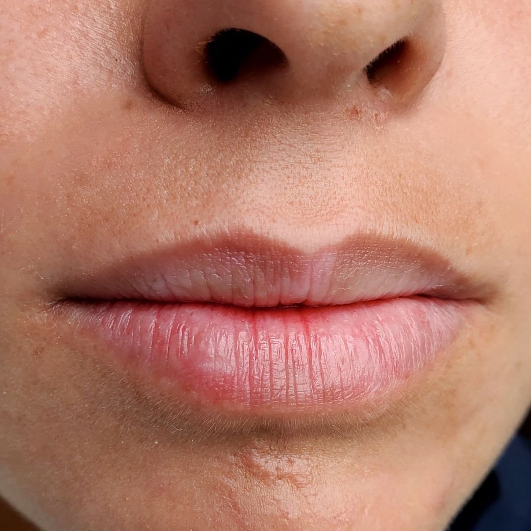 micropimentacion labios antes